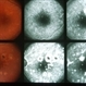 Choroiditis Choroiditis